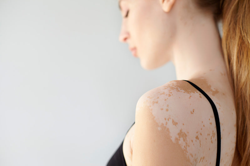 vitiligo peau 
